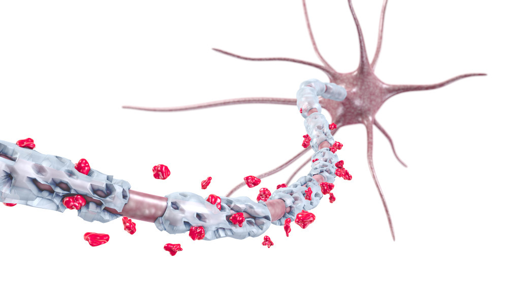 Nervenzelle mit geschädigter Myelinscheide