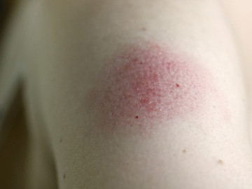 Rote Einstichstelle am Arm nach Impfung